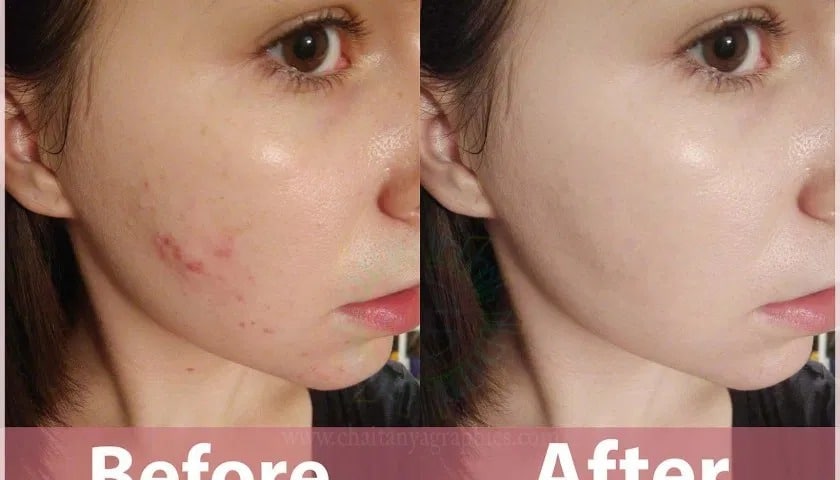 before after pimples